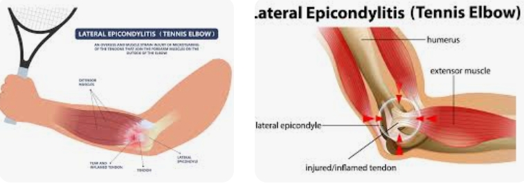 What is Tennis Elbow? Understanding the Condition, Its Impact, and Recovery Process